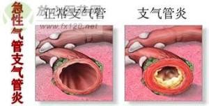 氣管炎的癥狀和表現,氣管炎的癥狀和表現圖縮略圖