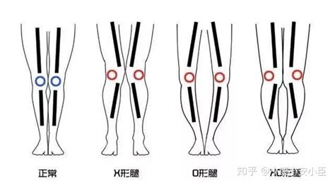 學(xué)步車真的會變O型腿嗎,學(xué)步車真的會變o型腿嗎視頻縮略圖