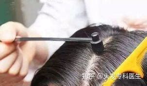 梅花針治療脫發多少錢一次,梅花針治療脫發多少錢一次貴嗎縮略圖
