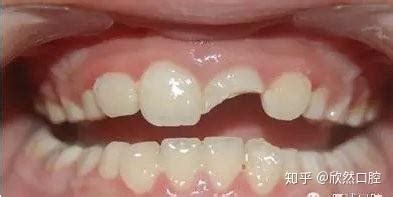 大門牙磕掉了一半怎么辦,補牙多少錢(大門牙磕掉了一半怎么辦,補牙多少錢蘇州)縮略圖