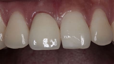 氧化鋯全瓷牙(氧化鋯全瓷牙和愛爾創全瓷牙有區別嗎)縮略圖
